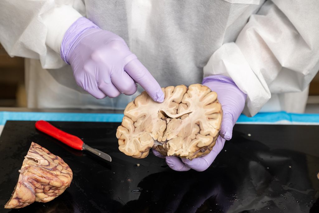 Close-up of a scientist wearing purple gloves pointing to a spot in the cut open half of the brain they are holding.